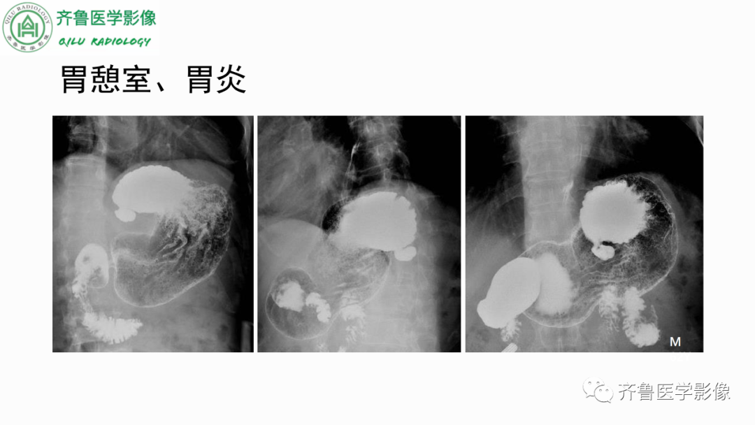 影像PPT - 【PPT】消化道憩室-8