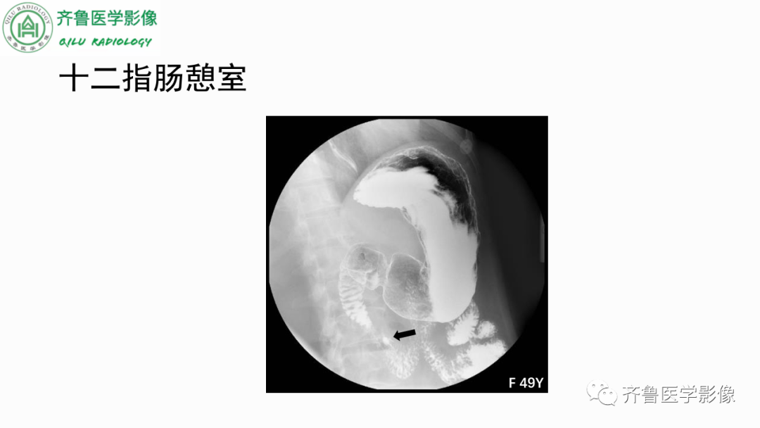 影像PPT - 【PPT】消化道憩室-9