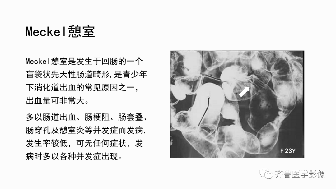 影像PPT - 【PPT】消化道憩室-11