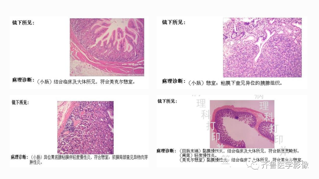 影像PPT - 【PPT】消化道憩室-16