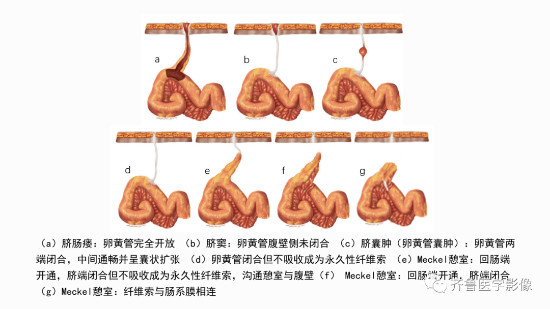 影像PPT - 【PPT】消化道憩室-13