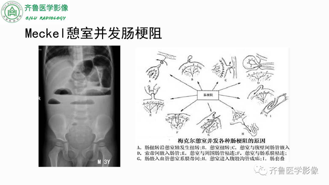 影像PPT - 【PPT】消化道憩室-20