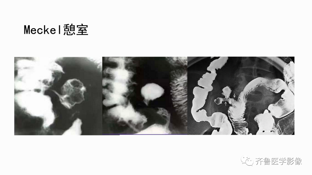 影像PPT - 【PPT】消化道憩室-18
