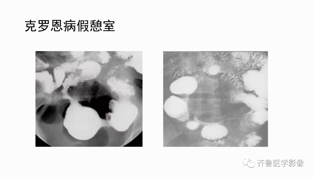 影像PPT - 【PPT】消化道憩室-23