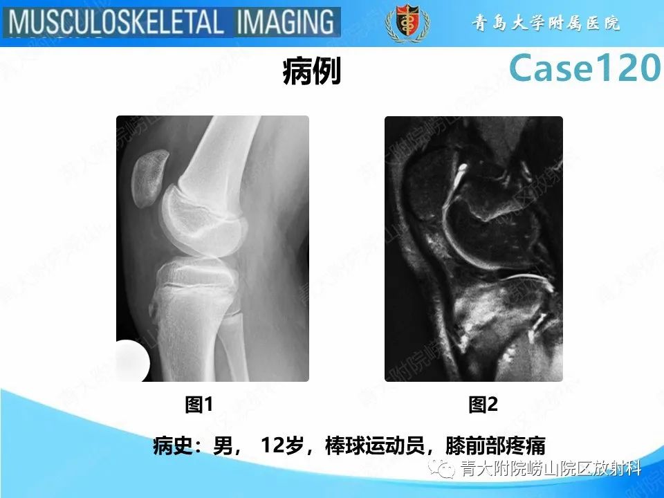 影像PPT - 【PPT】Osgood-Schlatter病-2