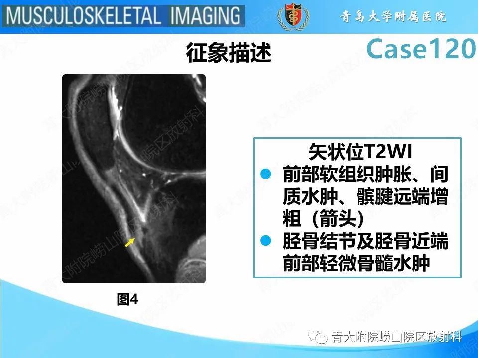 影像PPT - 【PPT】Osgood-Schlatter病-14