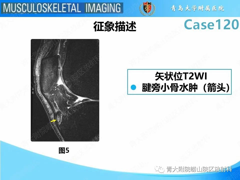 影像PPT - 【PPT】Osgood-Schlatter病-15