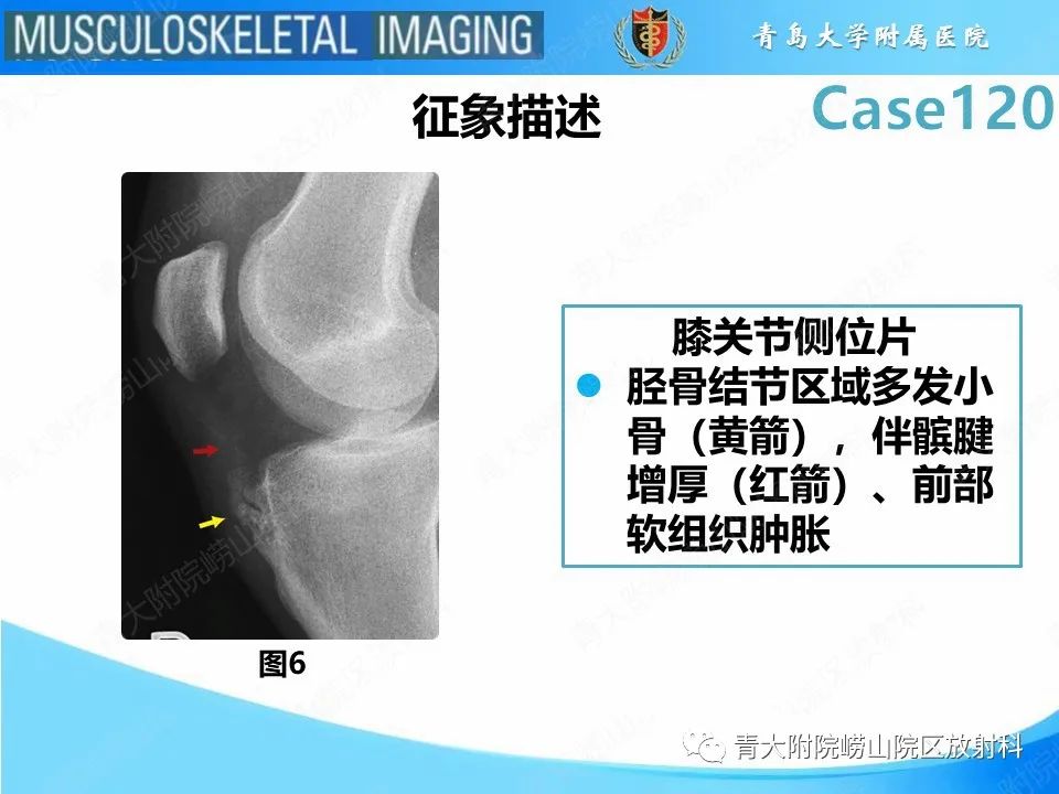 影像PPT - 【PPT】Osgood-Schlatter病-16