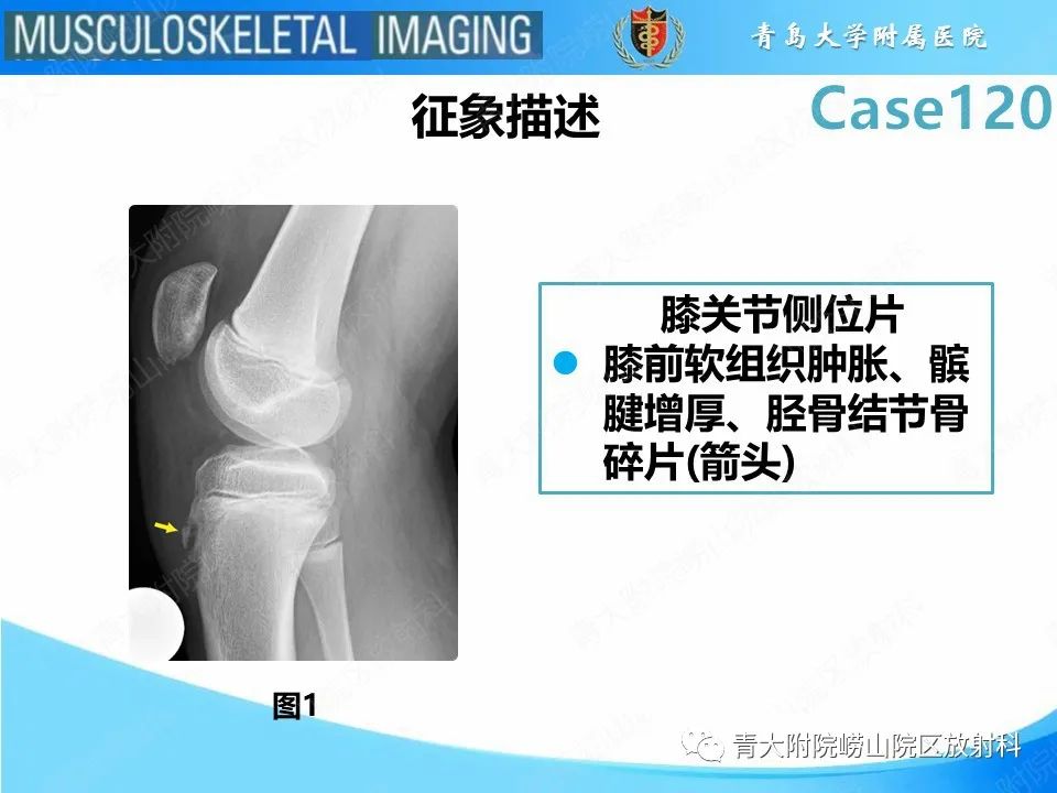 影像PPT - 【PPT】Osgood-Schlatter病-11