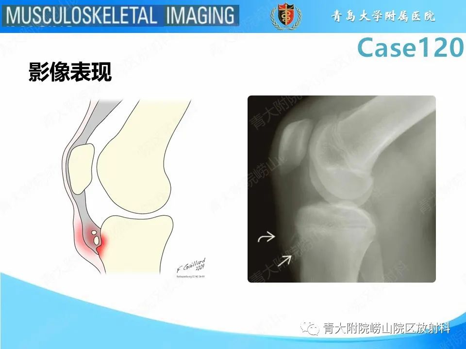 影像PPT - 【PPT】Osgood-Schlatter病-19
