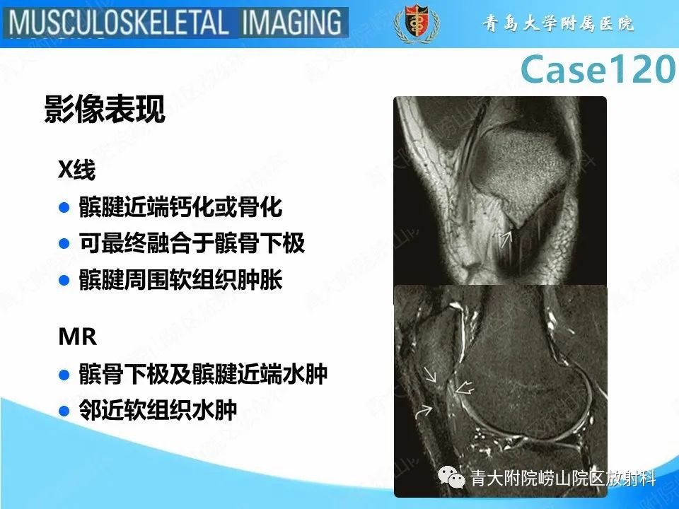 影像PPT - 【PPT】Osgood-Schlatter病-23