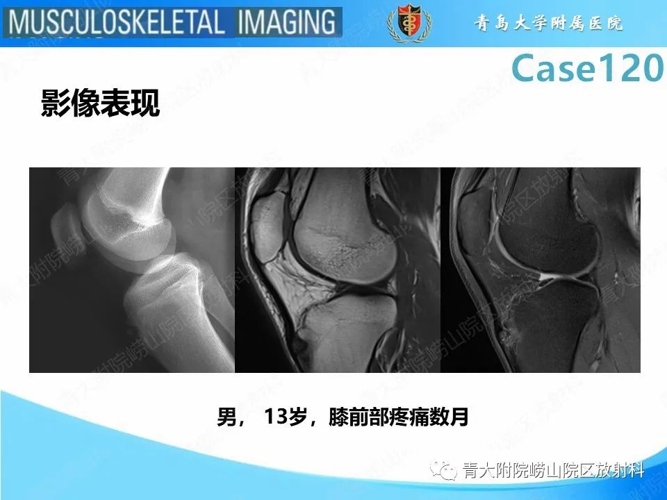影像PPT - 【PPT】Osgood-Schlatter病-21