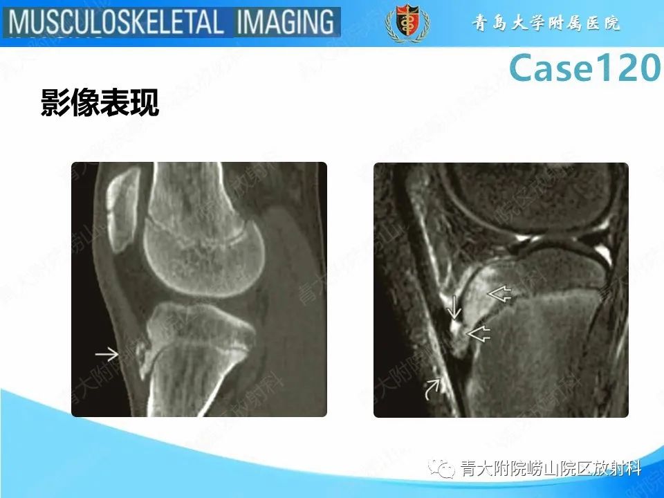 影像PPT - 【PPT】Osgood-Schlatter病-20