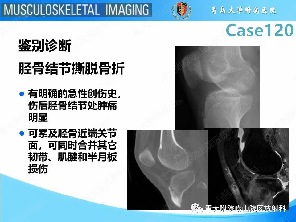 影像PPT - 【PPT】Osgood-Schlatter病-24