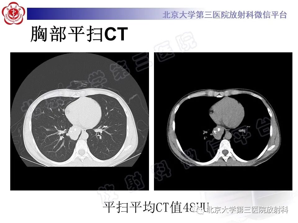 影像PPT - 【PPT】硬化性肺泡细胞瘤-3