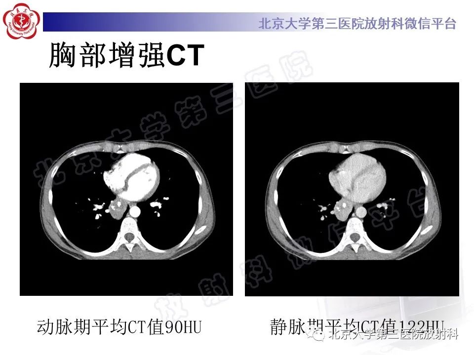 影像PPT - 【PPT】硬化性肺泡细胞瘤-4