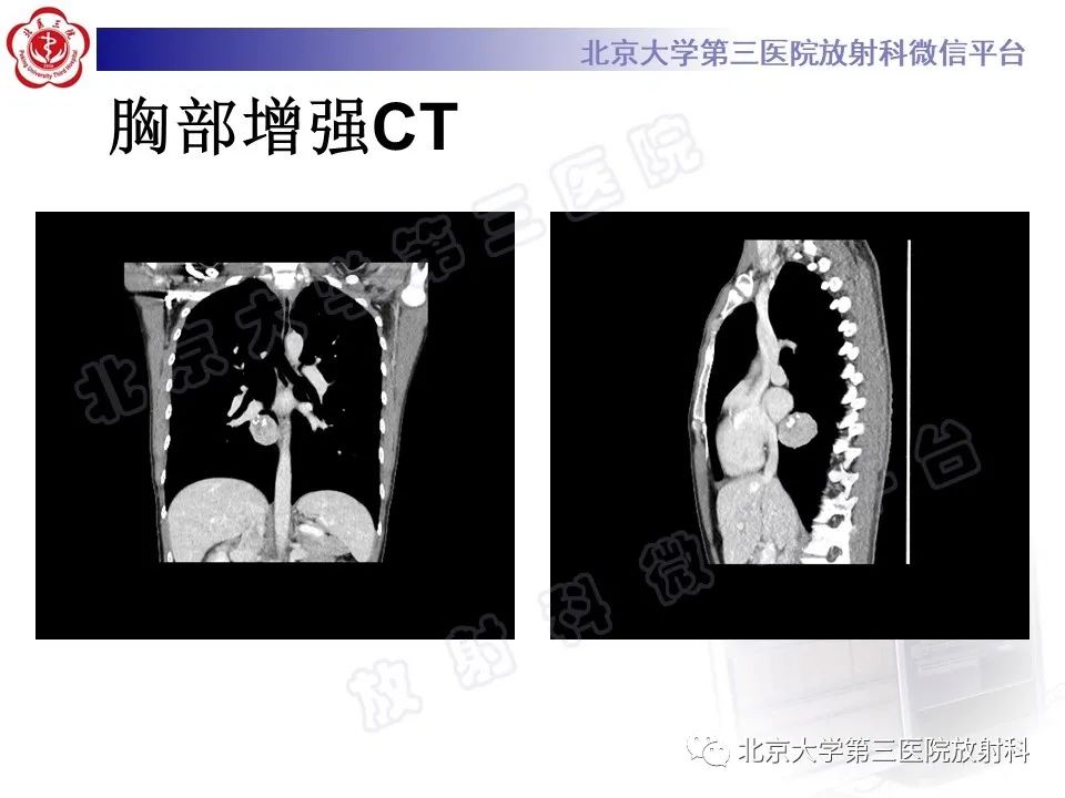 影像PPT - 【PPT】硬化性肺泡细胞瘤-5