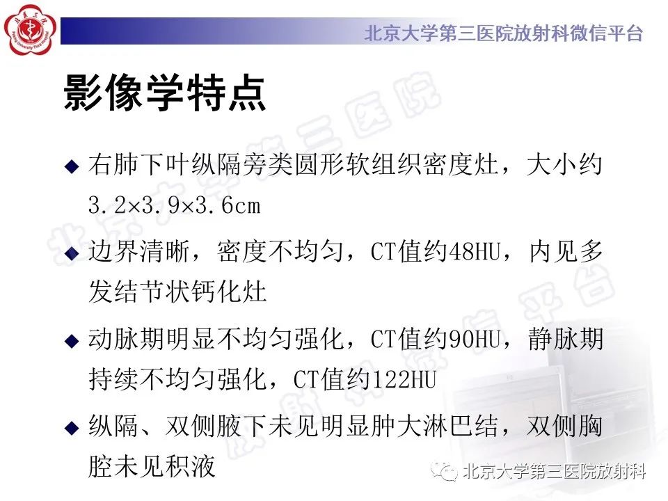 影像PPT - 【PPT】硬化性肺泡细胞瘤-6