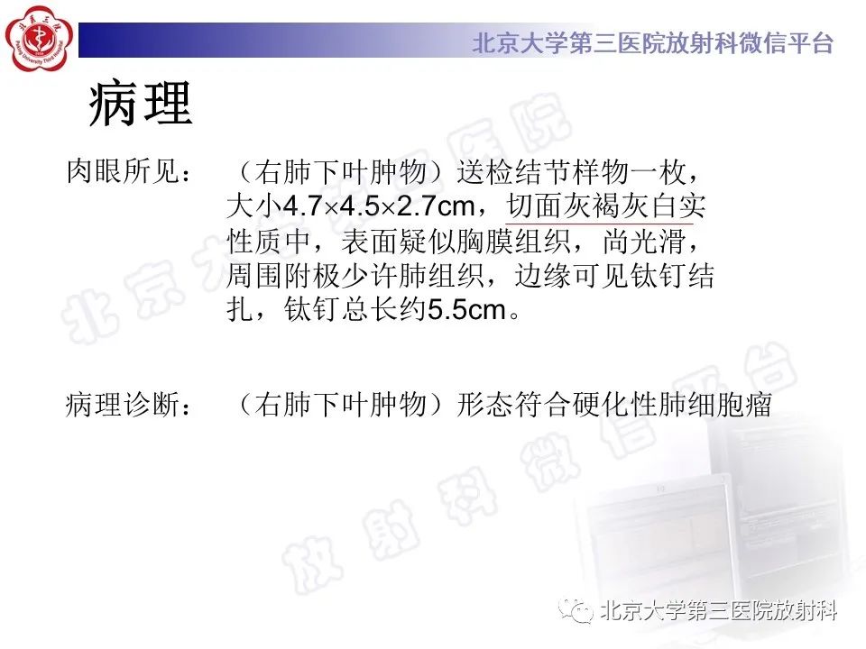 影像PPT - 【PPT】硬化性肺泡细胞瘤-9