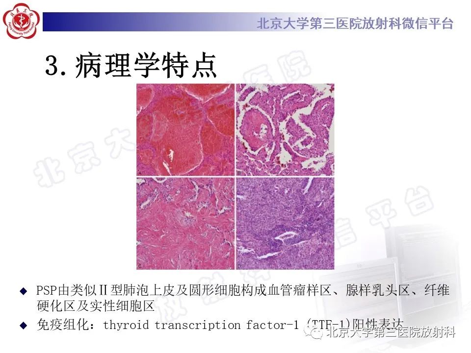 影像PPT - 【PPT】硬化性肺泡细胞瘤-13