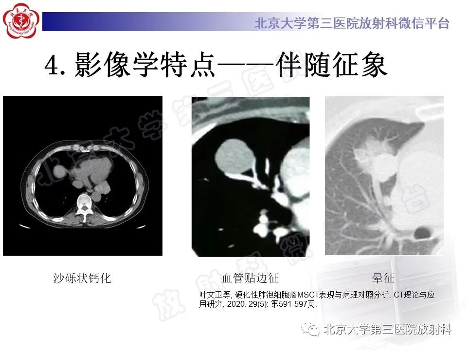 影像PPT - 【PPT】硬化性肺泡细胞瘤-16