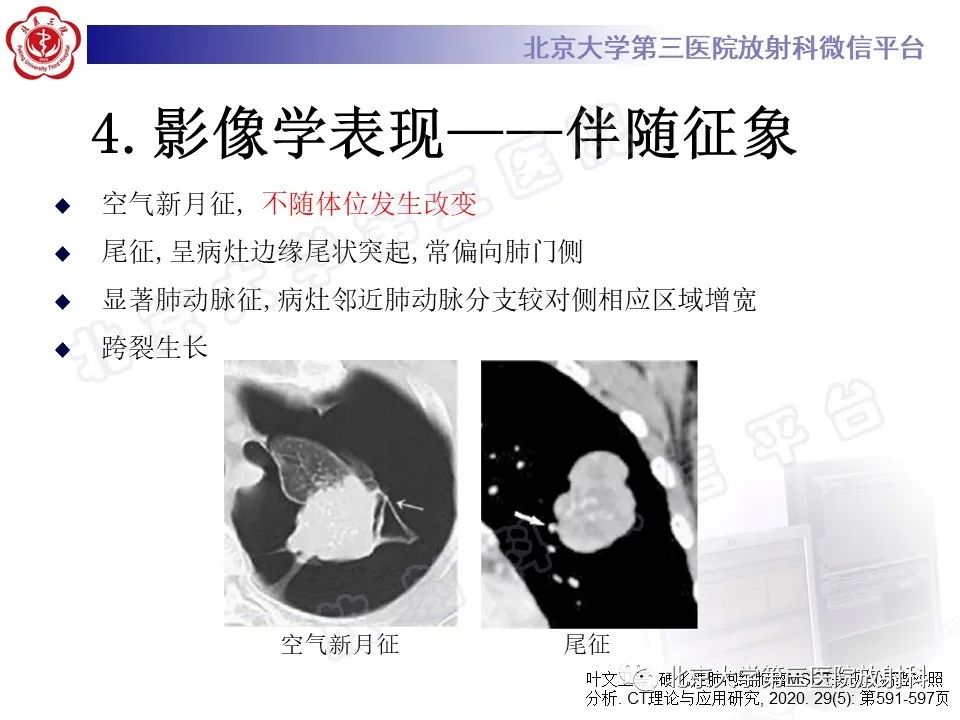 影像PPT - 【PPT】硬化性肺泡细胞瘤-17