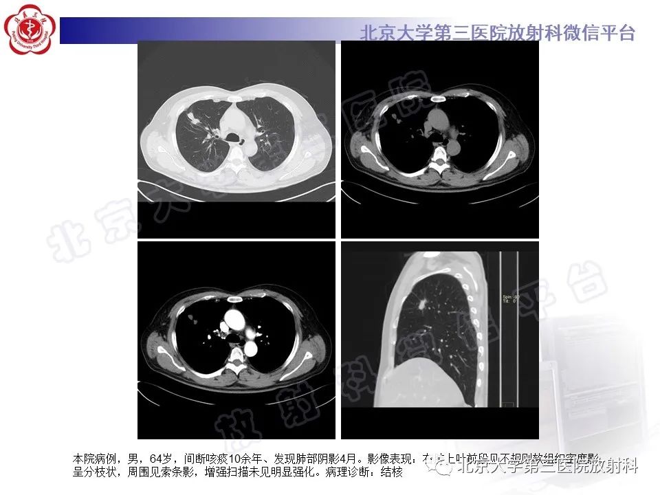 影像PPT - 【PPT】硬化性肺泡细胞瘤-21