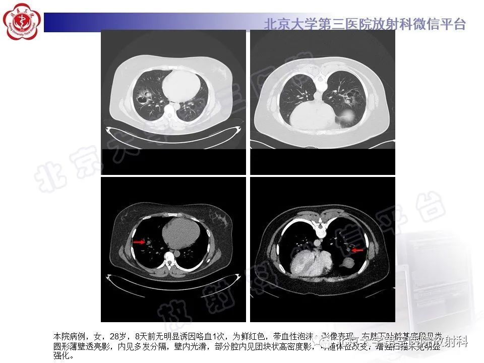 影像PPT - 【PPT】硬化性肺泡细胞瘤-24