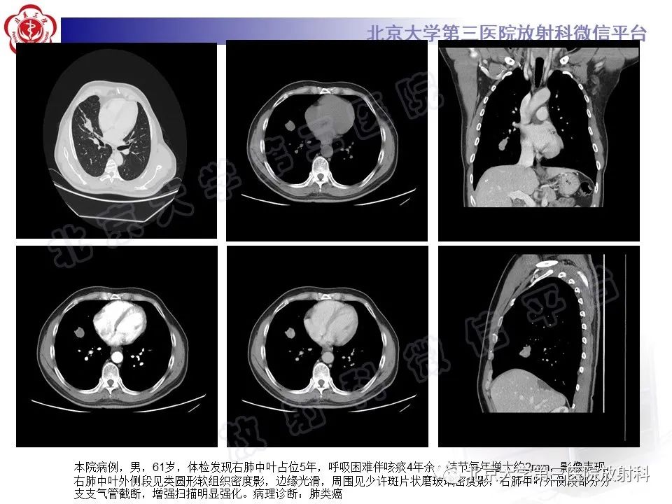 影像PPT - 【PPT】硬化性肺泡细胞瘤-26
