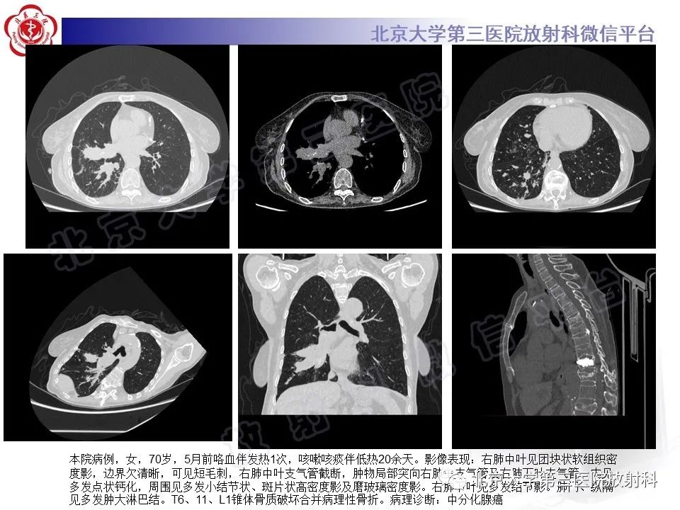 影像PPT - 【PPT】硬化性肺泡细胞瘤-28