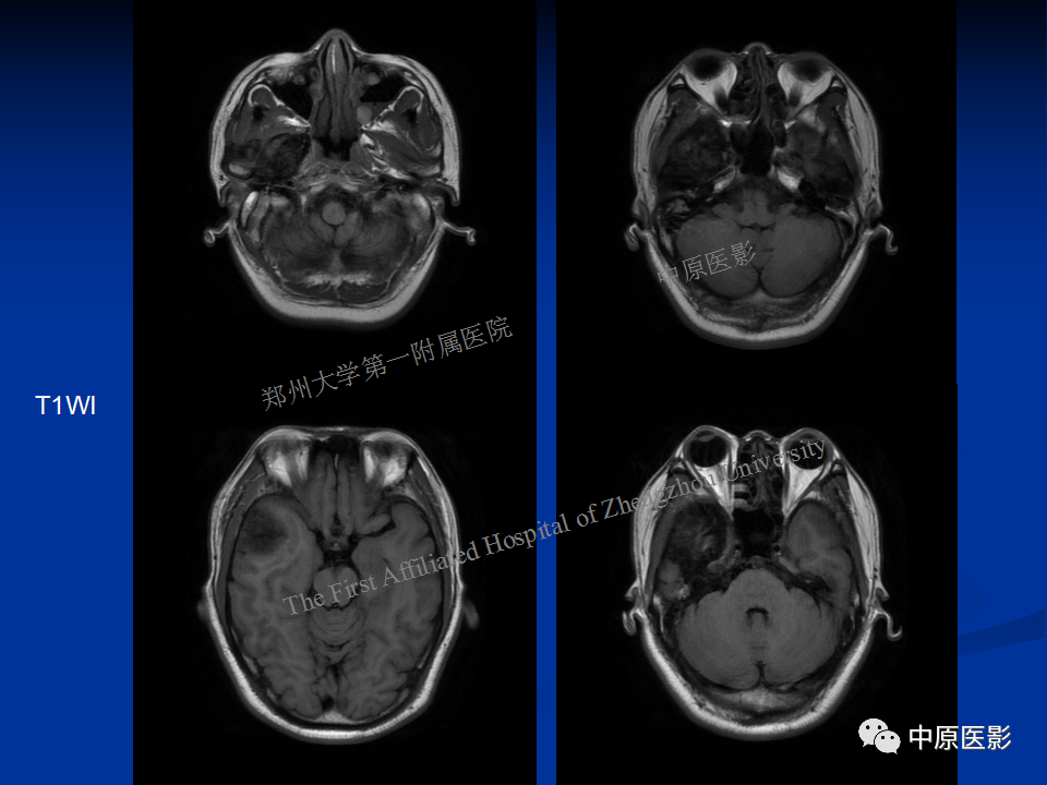 影像PPT - 【病例】颞下窝巨细胞修复性肉芽肿1例CT及MR-5