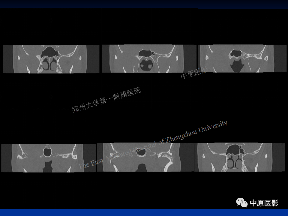 影像PPT - 【病例】颞下窝巨细胞修复性肉芽肿1例CT及MR-4
