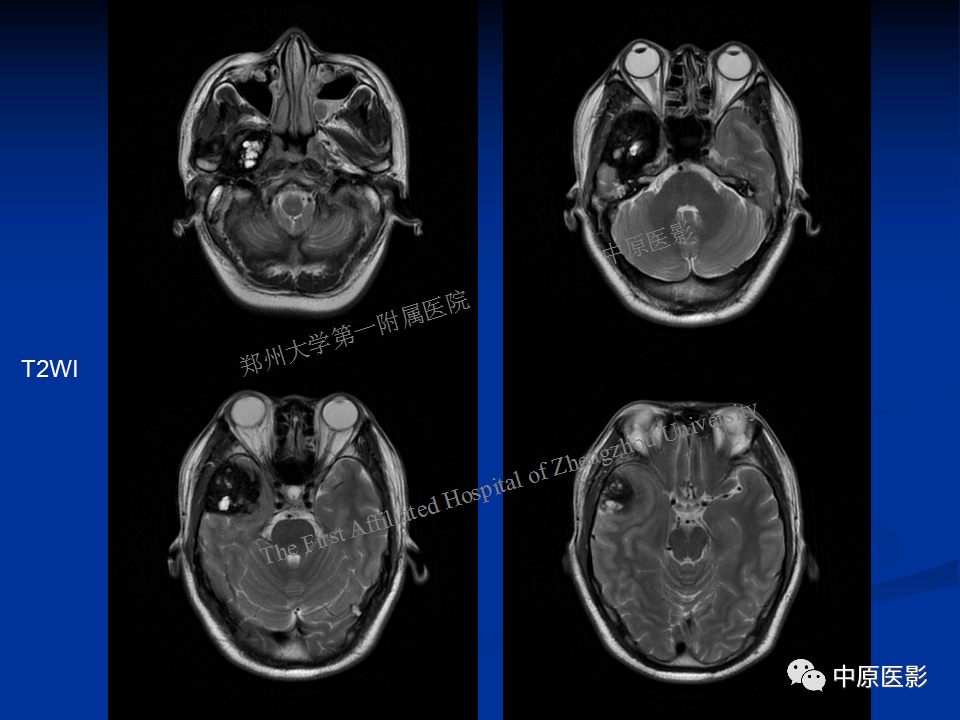 影像PPT - 【病例】颞下窝巨细胞修复性肉芽肿1例CT及MR-6