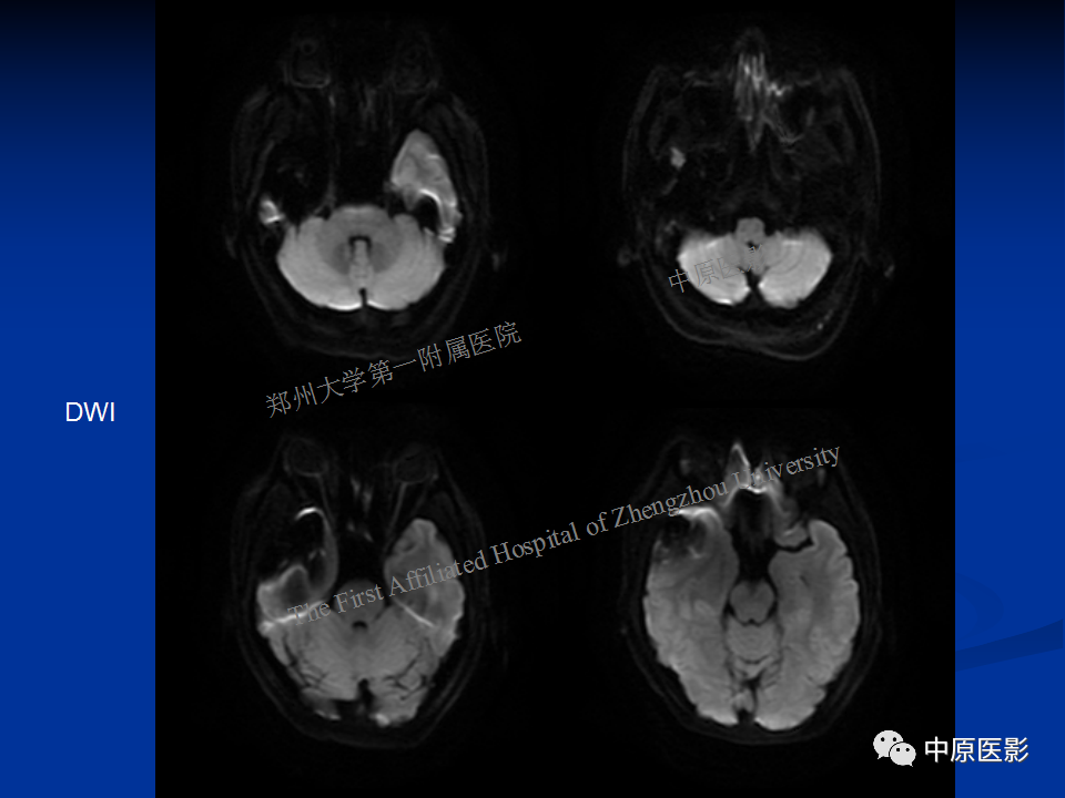 影像PPT - 【病例】颞下窝巨细胞修复性肉芽肿1例CT及MR-8