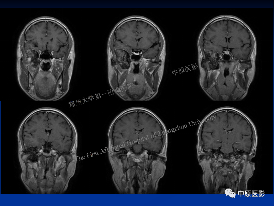 影像PPT - 【病例】颞下窝巨细胞修复性肉芽肿1例CT及MR-10