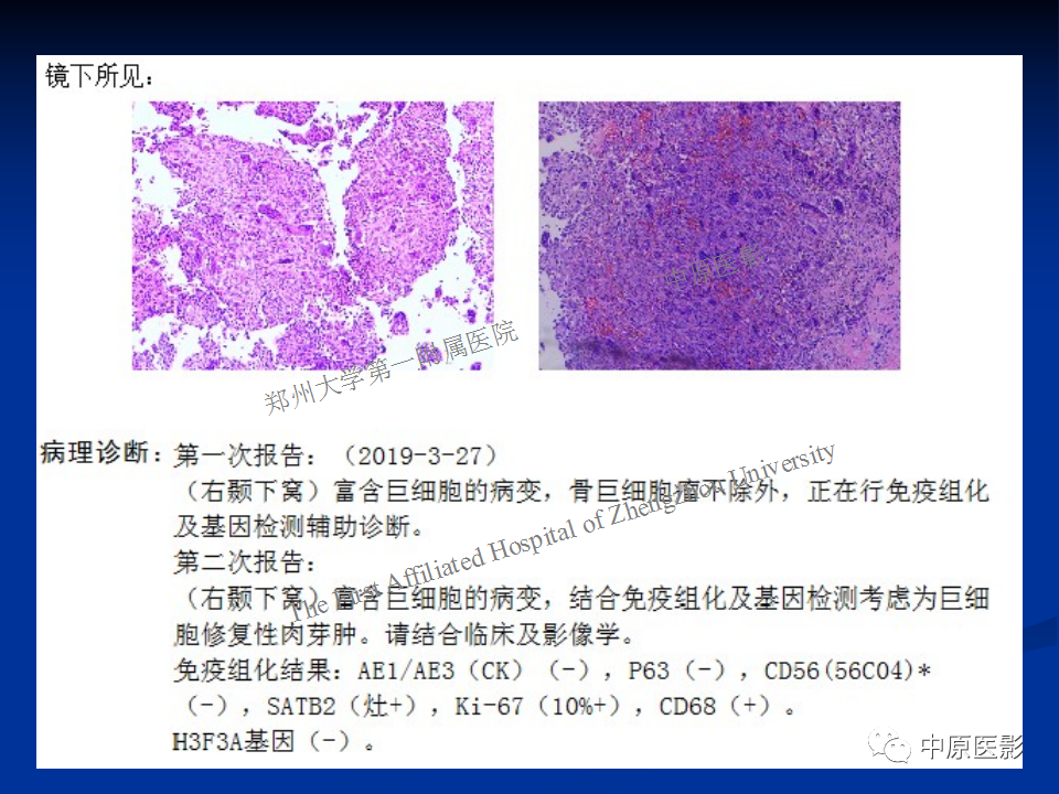 影像PPT - 【病例】颞下窝巨细胞修复性肉芽肿1例CT及MR-14