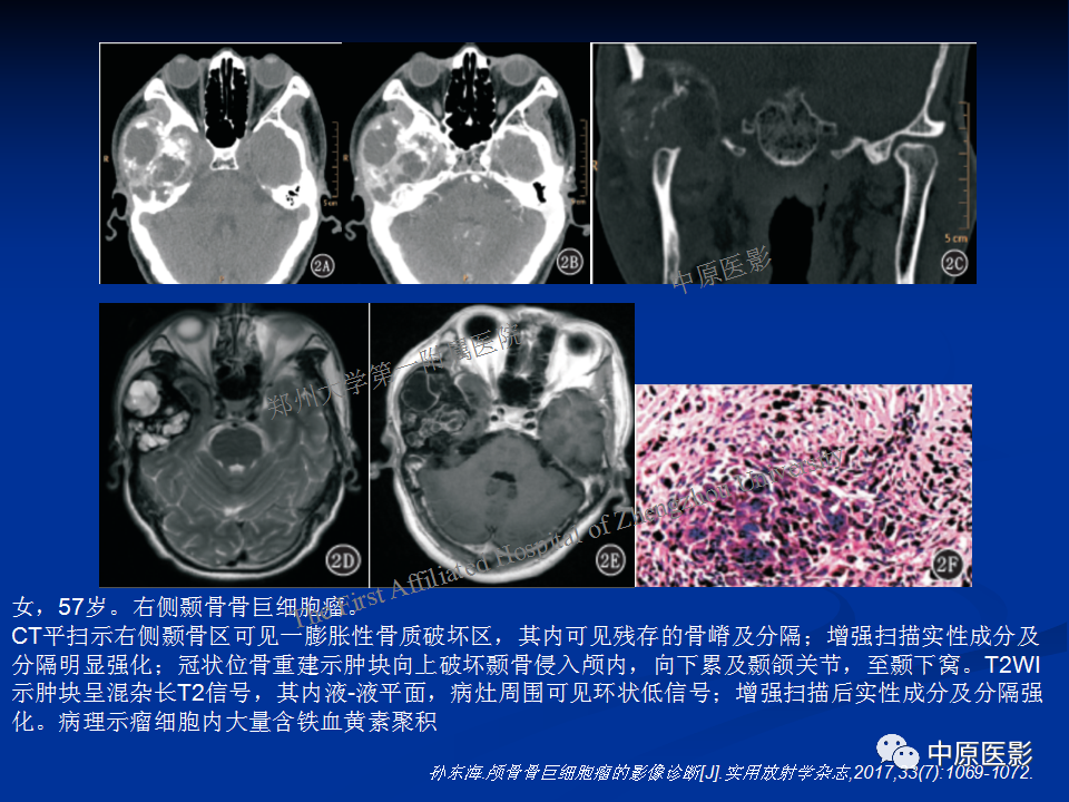 影像PPT - 【病例】颞下窝巨细胞修复性肉芽肿1例CT及MR-19