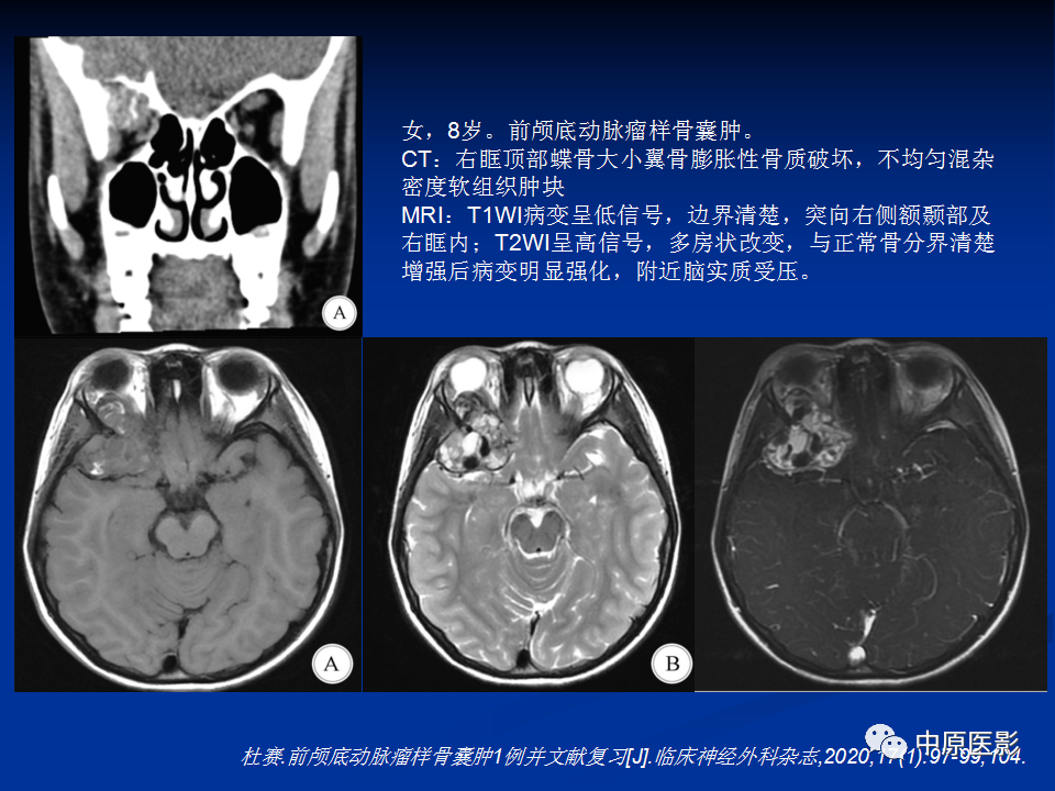 影像PPT - 【病例】颞下窝巨细胞修复性肉芽肿1例CT及MR-22