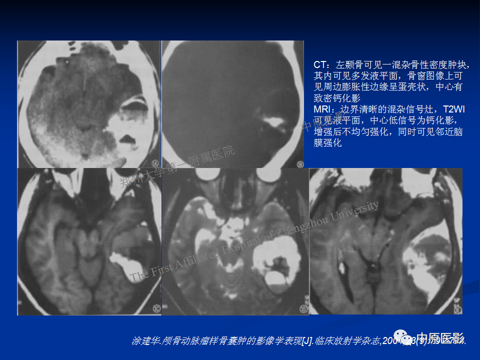 影像PPT - 【病例】颞下窝巨细胞修复性肉芽肿1例CT及MR-23