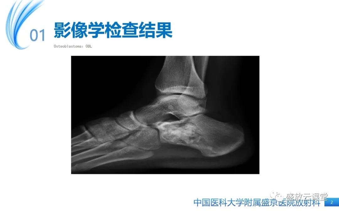 影像PPT - 【PPT】骨母细胞瘤-2