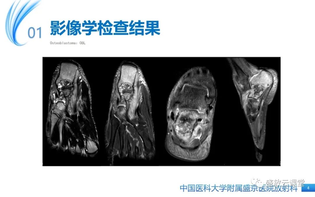 影像PPT - 【PPT】骨母细胞瘤-4