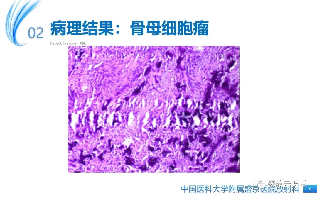 影像PPT - 【PPT】骨母细胞瘤-6