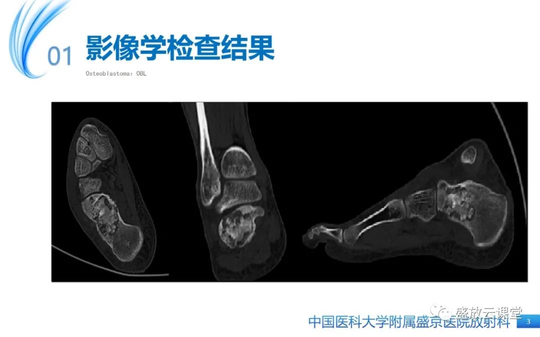 影像PPT - 【PPT】骨母细胞瘤-3