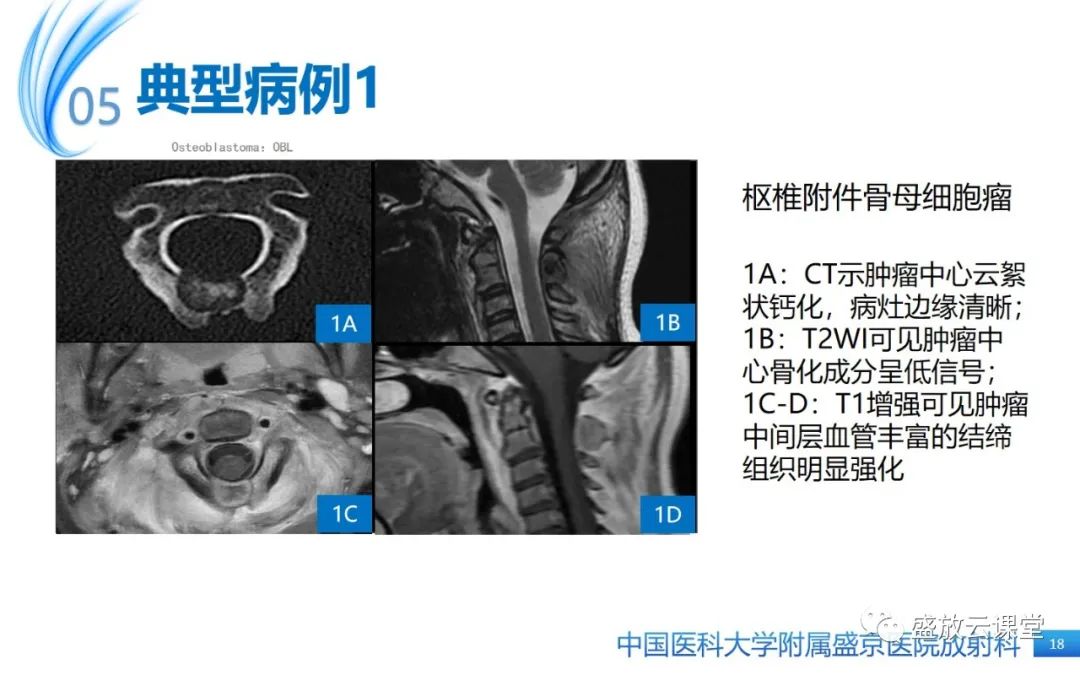 影像PPT - 【PPT】骨母细胞瘤-18