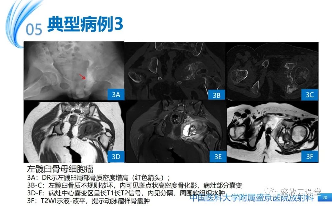 影像PPT - 【PPT】骨母细胞瘤-20