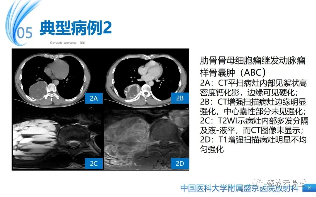 影像PPT - 【PPT】骨母细胞瘤-19