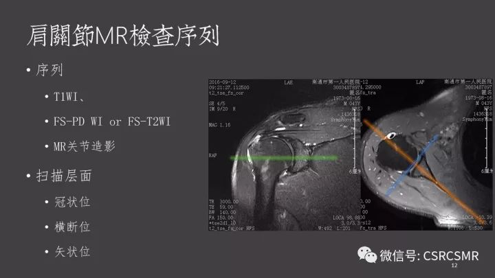 影像PPT - 【PPT】肩关节MRI的结构式评估-12