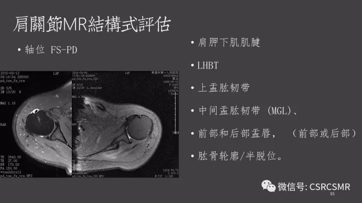 影像PPT - 【PPT】肩关节MRI的结构式评估-15