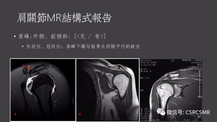 影像PPT - 【PPT】肩关节MRI的结构式评估-26
