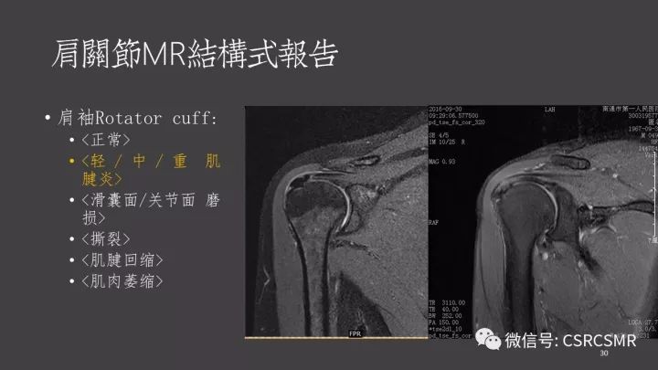 影像PPT - 【PPT】肩关节MRI的结构式评估-30